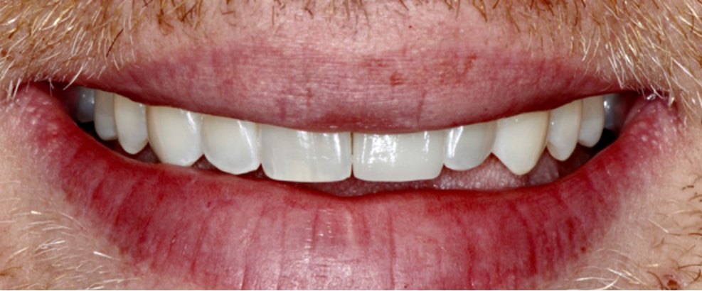After: the gap filled with an implant and crown